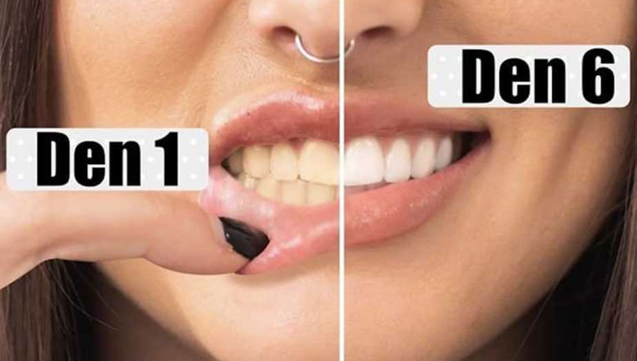 Bělení zubů doma: Jaké máme možnosti?